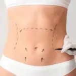Come alzarsi dal letto dopo un'addominoplastica Addominoplastica